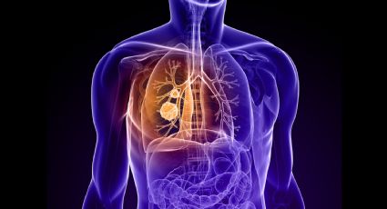 El 15% de los pacientes de cáncer de pulmón no son fumadores: la contaminación es la culpable