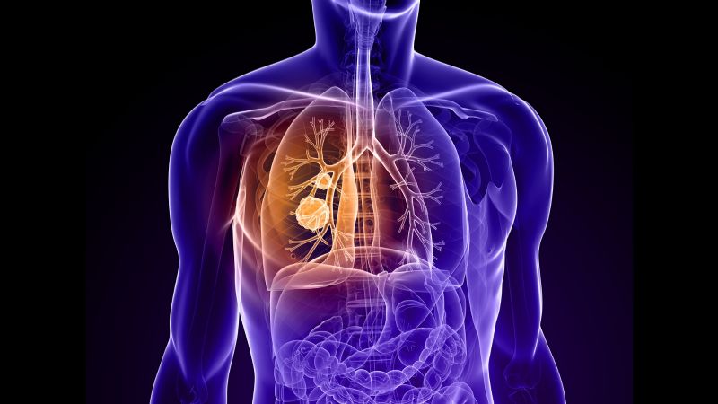 El 15% de los pacientes de cáncer de pulmón no son fumadores: la contaminación es la culpable
